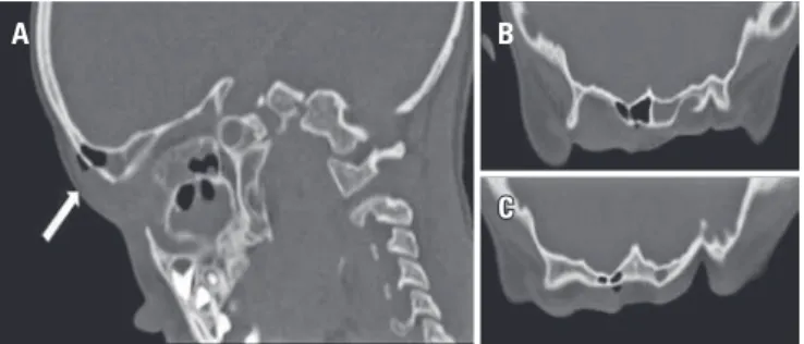 Figure 1. (A) Right parasagittal plane, (B) supraorbital transverse plane and (C)  frontal transverse plane