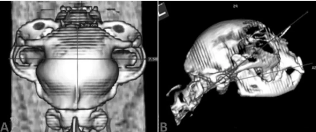 Figure 2. Ilustrative tomographic images of  craniometric  measurements, linear (A) and angular (B), through  3D reconstruction, using DICOM Viewer software