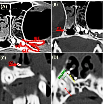 Figure 1. Contrast-enhanced CT. A – Cross-sectional image acquired at the level of the infraorbital canal