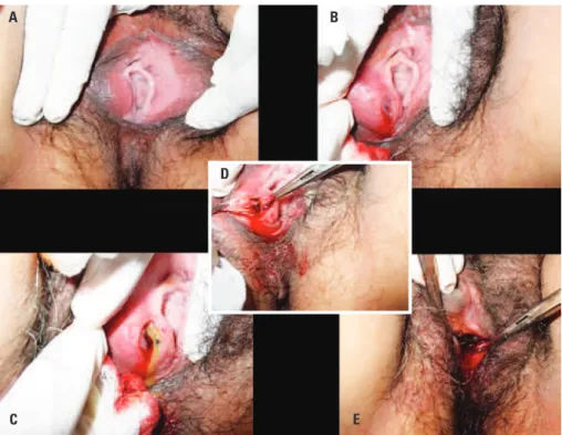 Figure 1.  Procedure with CO 2  laser in the treatment of a Bartholin cyst. (A) Exposure of the cyst to the right, with 2% xylocaine infiltration