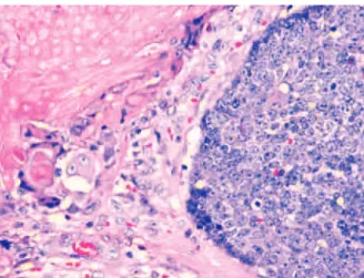 Figure 1. The pre-operative image shows a diffuse swelling in the left pre- pre-auricular region producing an impression of a parotid mass