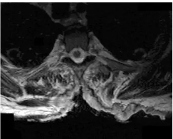 Figure 3. Axial view of the spine at T5 using magnetic resonance imaging  demonstrating absence of spinal cord involvement