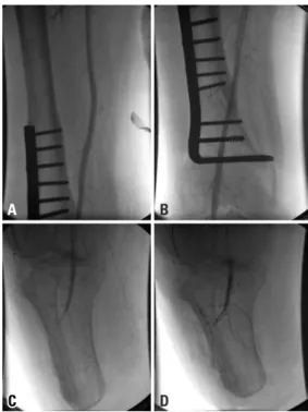 Figure 4. Final angiography demonstrated patency of the superficial femoral and  popliteal arteries, without residual stenosis or thrombus