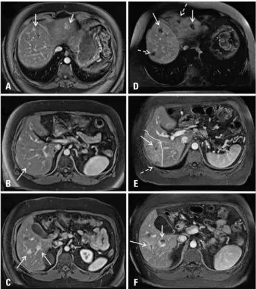 Figura 1. Ressonância magnética de abdome superior em T1 com saturação  de gordura pós-contraste, na fase portal, no plano axial, evidenciando lesões  secundárias hepáticas nos (A) segmentos II e IVa (setas brancas), (B) segmento  VII (seta branca) e (C) n