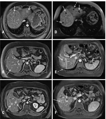 Figure 1. Upper abdomen magnetic resonance, T1-weighted with fat saturation  after contrast, in portal phase, axial section, showing secondary hepatic lesions  in (A) segments II and IVa (white arrows), (B) segment VII (white arrow) and (C)  segment VI (wh