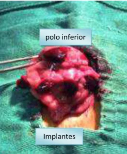 FIGURA 3 - Implantes esplênicos autógenos suturados  ao omento maior 