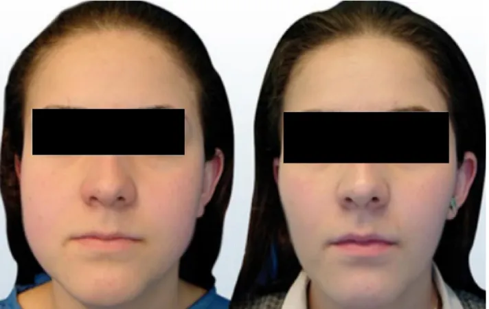 Figura 2: Antes e depois de cirurgia para remoção da bola de Bichat, notar melhora estética no terço medio e inferior da face