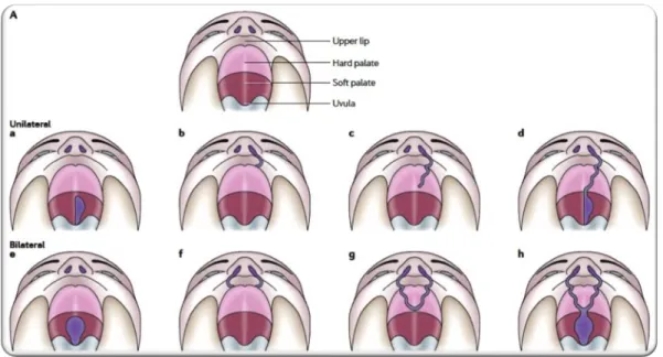 Figura 3. Desenhos ilustrativos de diversos tipos de fenda do lábio e/ou palato. (a e e) Fenda unilateral e bilateral  do palato mole; (b,c,d) Diversos  graus  de fenda do lábio e  palato unilateral