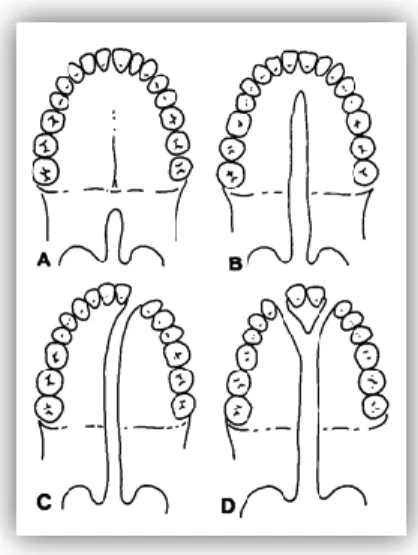 Figura 5. Classificação de Veau (1931). (A) Fendas de palato mole posterior até ao palato duro