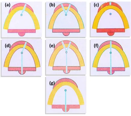 Figura  10.  Tipos  de  fendas  lábio-palatinas  (a)  Fenda  pré-foramen  incisivo  unilateral  completa