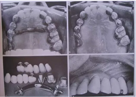 Figura  2  -  PRICHARD,  J.  P.  Prosthetic  procedures  in  the  management  of  periodontal  disease
