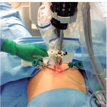 Figure 1.  A 2.5cm umbilical incision to dissect the peritoneal cavity