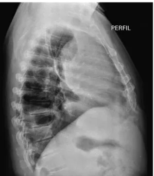 Figura 3. Tomografia de tórax com contraste, corte coronal, evidenciando o  contato da massa mediastinal com a aorta e o tronco pulmonar (seta)