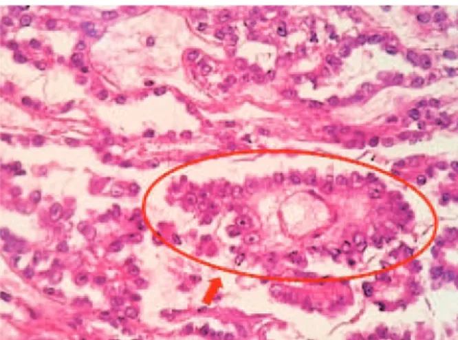 Figura 4. Histopatologia do tumor de saco vitelínico (coloração com  hematoxilina-eosina, 20x)