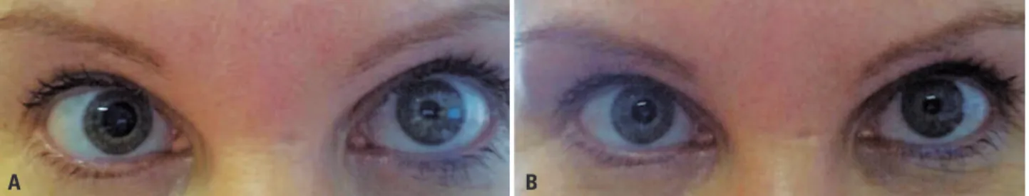 Figure 1. Patient with anisocoria after use cosmetic product and isocoric after discontinuing the use of the product