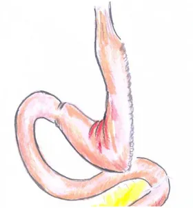 Figura 2 – Gastrectomia Vertical (aspecto final). 