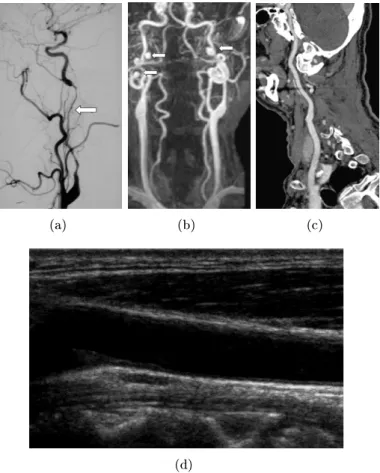 Fig. 1.5: Arteriosclerosis diagnosis exams: (a) conventional angiography; (b) MR angiog- angiog-raphy; (c) CT; (d) ultrasonography [Schaller, 2007].