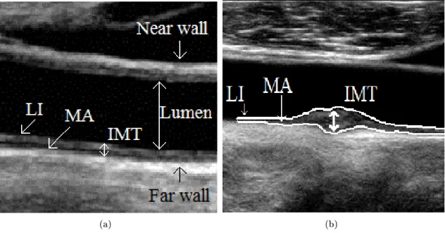 Fig. 2.1: Artery structure on a B-mode ultrasound image: (a) normal carotid; (b) patho- patho-logical carotid