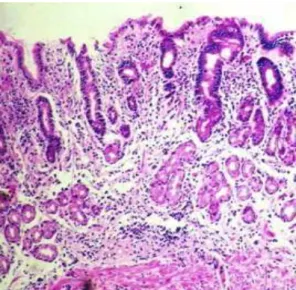 FIGURA 4. Mucosa gástrica oxíntica mostrando atrofia glandular moderada, paciente com  gastrite auto-imune