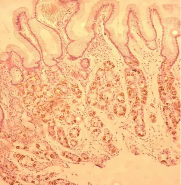 FIGURA 5. Células parietais da mucosa gástrica oxíntica em pequenos aglomerados na base  da mucosa, paciente com gastrite auto-imune