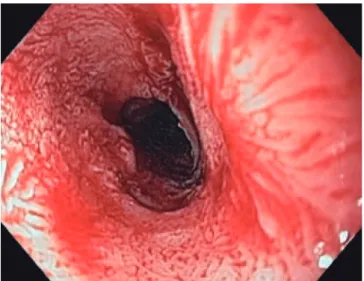 Figure 1. Extensive papillary lesion involving the whole esophageal  circumference in patient 1