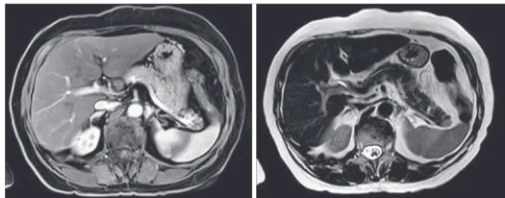 Figure 1. Abdominal magnetic resonance imaging (T1 and T2)