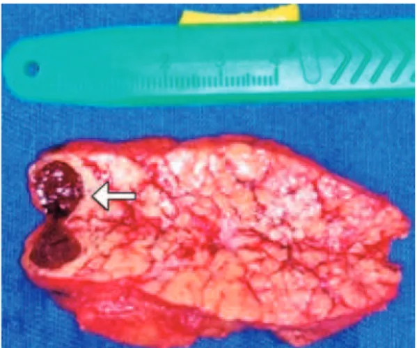 Figure 3. Surgical sample of distal pancreatectomy with intrapancreatic ectopic  spleen 