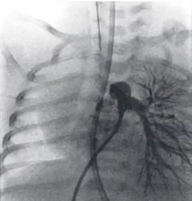 Figura 2. Angiografia aórtica mostra circulação colateral exuberante no pulmão  direito