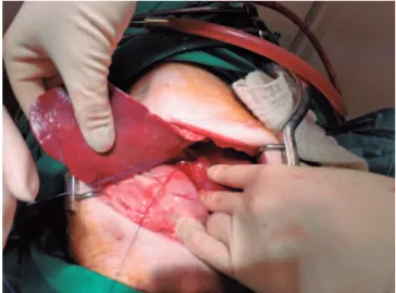 Figure 1. Ligature of the branch of the portal vein responsible for vascularization  of the medial and lateral left lobe segments