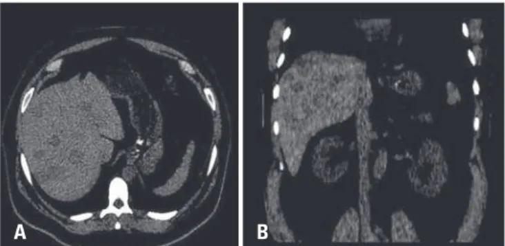 Figura 1. (A) Tomografia computadorizada sem contraste, evidenciando múltiplos  nódulos hepáticos hipoatenuantes