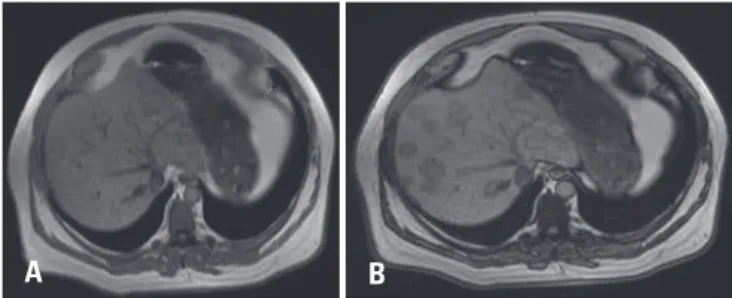 Figure 2. (A) Post-contrast computed tomography on axial A and coronal  reformatted. (B) Showing multiple hypoattenuating liver nodules