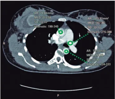 Figura 1. Densidade do contraste na artéria pulmonar de 147,13, densidade do  contraste na aorta ascendente de 292,45 e densidade do contraste na aorta  descendente de 271,64