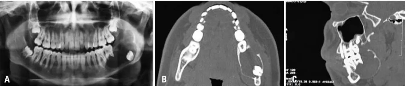 Figura 1. (A) Radiografia panorâmica pré-cirúrgica. Observar lesão radiolúcida, padrão unicístico, unilocular, zonas de transição definidas por uma fina margem  esclerótica, discretamente insuflativa, estendendo do corpo mandibular ao ramo ascendente esque