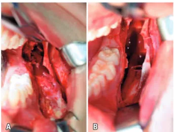 Figure 3. (A) Prepared recipient site. The bone grafting technique defined with  the use of rhBMP-2