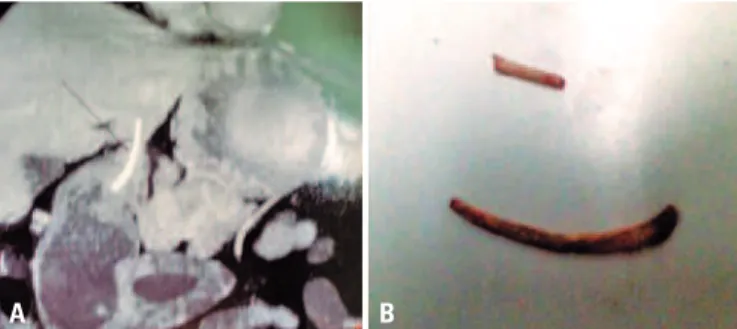 Figure 1. (A) Endoscopy showing a bulge in gastric antrum adjacent to the  pylorus. (B) Endoscopic ultrasound revealed the lesion as compatible with  a gastrointestinal stromal tumor, but abdominal computed tomography was  recommended