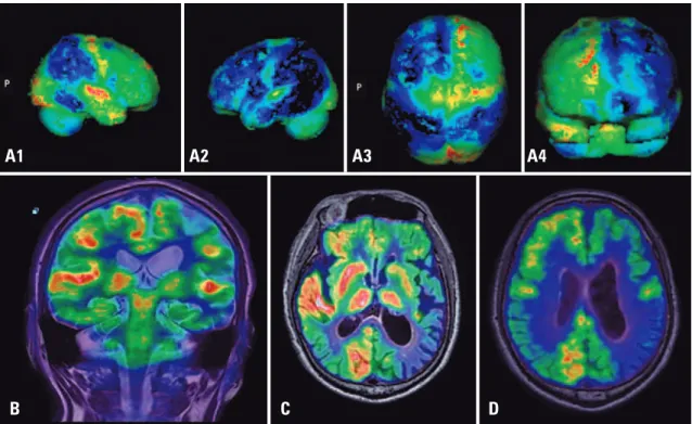Figure 5. Brain  18 F-FDG PET/MRI images of a male patient with Parkinson’s disease and cognitive impairment, showing glucose metabolism deficit and volumetric  reduction in the left cerebral hemisphere