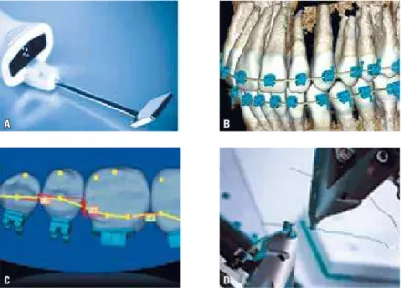 FIGURE 2 -  A ) Intraoral Scanner;  B ) 3-D individualized model;  C ) Robotic wire bending;  D ) Individual- Individual-ized tooth wire bending