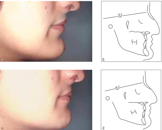 FIGURA 1C - Closes do perfil e traçados cefalométricos antes (a, b) e após (c, d) a realização de cirurgia de redução do mento, executada pelo Dr