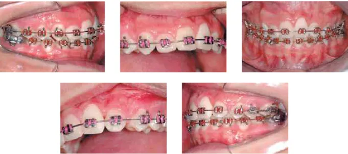 FIGURE 3I - At the end of leveling, occlusion was corrected with molar and canine in Class I relationship on the right side, and tooth 23 in the position of  the lateral incisor (canine bracket placed upside down), tooth 24 in the position of the canine (w