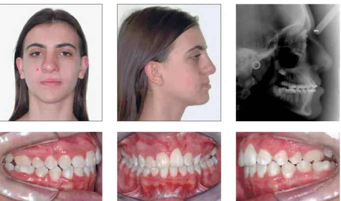 FIGURE 3K - At the end of treatment, adequate occlusion outcome. The face features pattern III characteristics due to maxillary deficiency, with greater soft  tissue involvement, acceptable skeletal and dental relations (see lateral cephalogram)