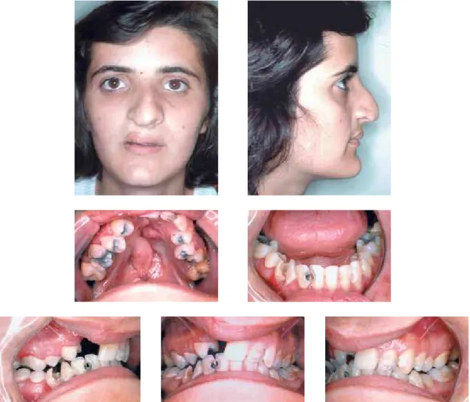 FIGURE 1A - Young patient, 17 years and 3 months of age with unilateral cleft lip and palate operated on as a child, showing scars marking the lip and  nasal deformity, but Pattern I face