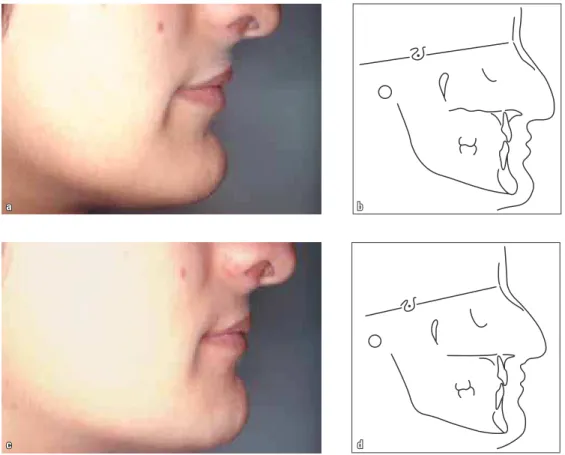 FIGURE 1C - Profile close-up and cephalometric tracings before (a, b) and after (c, d) chin reduction surgery performed by Dr