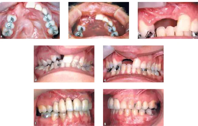 FIGURE 1D - Upper dental arch, before (a), immediately after placement of late bone graft (b), and alveolar area repaired (no cleft) after healing (c)