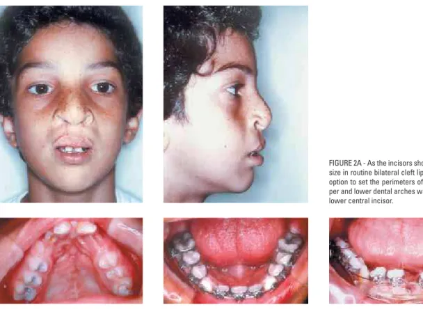 FIGURE 2A - As the incisors show a reduction in  size in routine bilateral cleft lip and palate, one  option to set the perimeters of the anterior  up-per and lower dental arches was to extract one  lower central incisor.