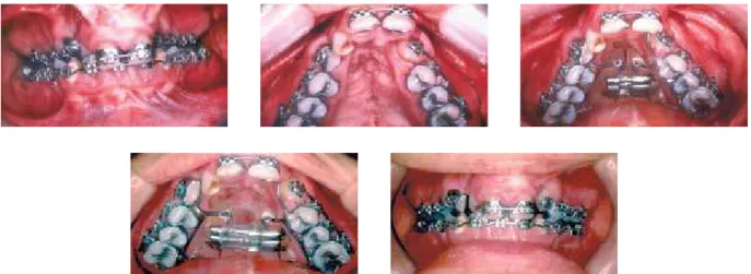 FIGURE 2B - Leveled and aligned dental arches, with the upper arch in segments, which was routine prior to expansion