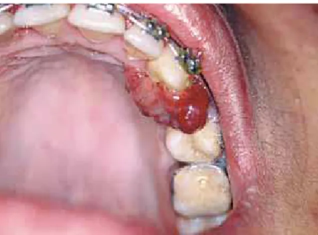 FIGURE 2 - Hyperplastic lesion between teeth 42 and 43 stemming from the  keratinized gingiva and indicative of inflammatory gingival hyperplasia.