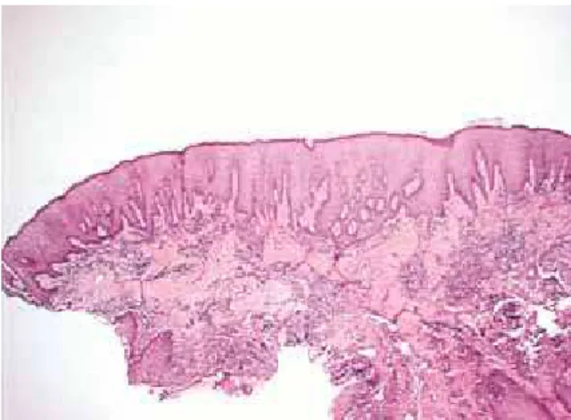 FIGURE 3 - Histological section of pyogenic granuloma (original color: HE; 