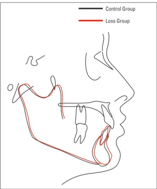 FIGURE  1  -  Mean  differences  observed  between  the  control  group  (black  tracing)  and  the  group  with  bilateral  loss  of  lower  first  molar  (red tracing).