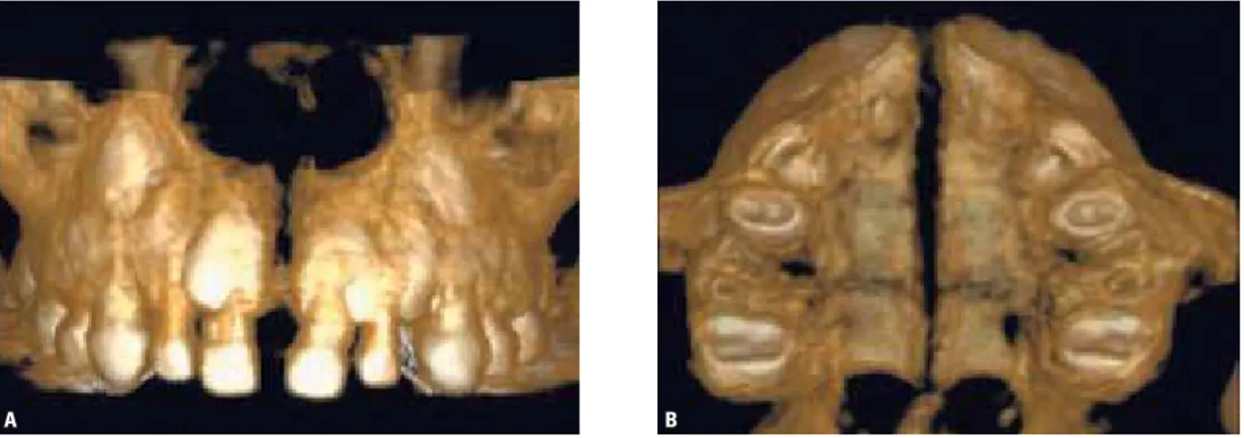 FIGURE 3 - Three-dimensional occlusal reconstruction of the maxilla from a CT scan, showing the open midpalatal suture: ( A ) posteroanterior view; ( B ) oc- oc-clusal view.