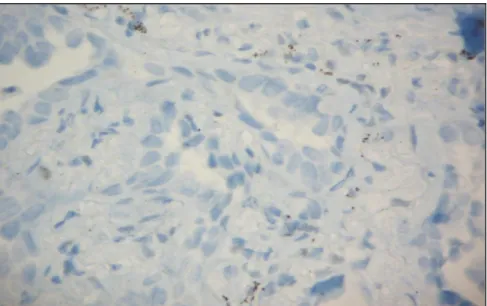 Figura 4: Exemplo de caso interpretado como negativo. Glândulas de adenocarcinoma são  claramente visíveis, em azul (negativo)
